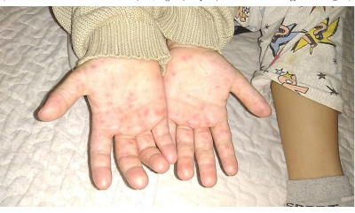 SECRETARIA DE SAÚDE ALERTA PAIS PARA SÍNDROME CONTAGIOSA ENTRE CRIAÇAS DE ATÉ 5 ANOS. SECRETARIA DE SAÚDE ALERTA PAIS PARA SÍNDROME CONTAGIOSA ENTRE CRIAÇAS DE ATÉ 5 ANOS.